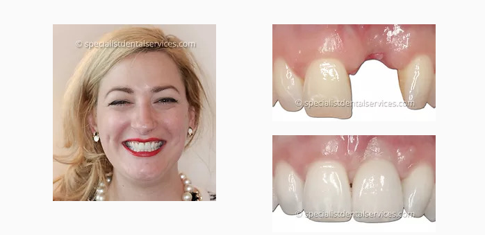 Chipped Teeth repair in London Ontario - London Ontario Dental Clinic