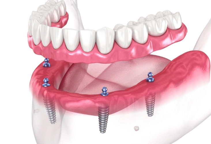 Cost of a Full Mouth Dental Implant Procedure