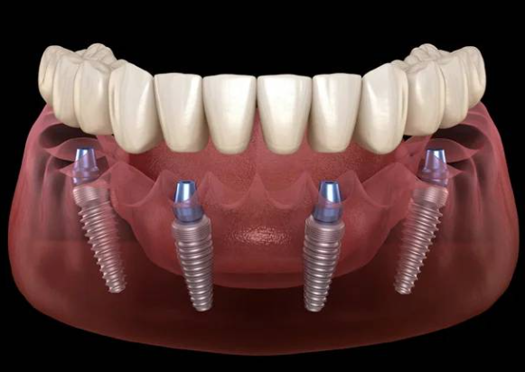 Cost of a Full Mouth Dental Implant Procedure: Is It Worth It?