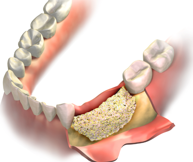 Types of Bone Grafting
